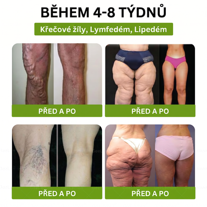 🌿Luxarise®Glumasetide 8v1 Stihla a zdrava nano mikrojehlickova naplast(1krát denně – viditelné změny až za 7 dní) ✅Pro obezitu, zpevnění kůže, cukrovku, spánkovou apnoe, klouby atd.
