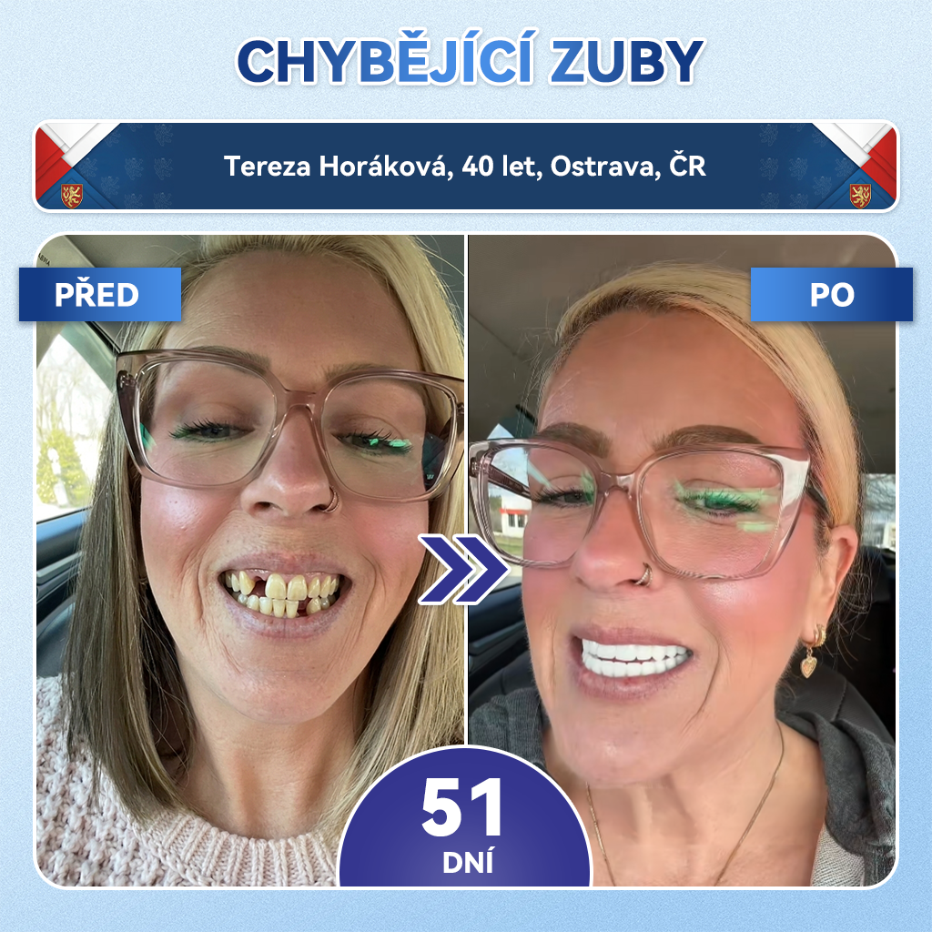 🦷Glimmerly® Microneedle naplast pro opravu zubi a dasni s Tideglusibem  |Pokročilé zubní pásky s aktivací kmenových buněk (obnovuje sklovinu a dentin • posiluje dásně • odstraňuje plak a zápach • zastavuje citlivost zubů) 3.0