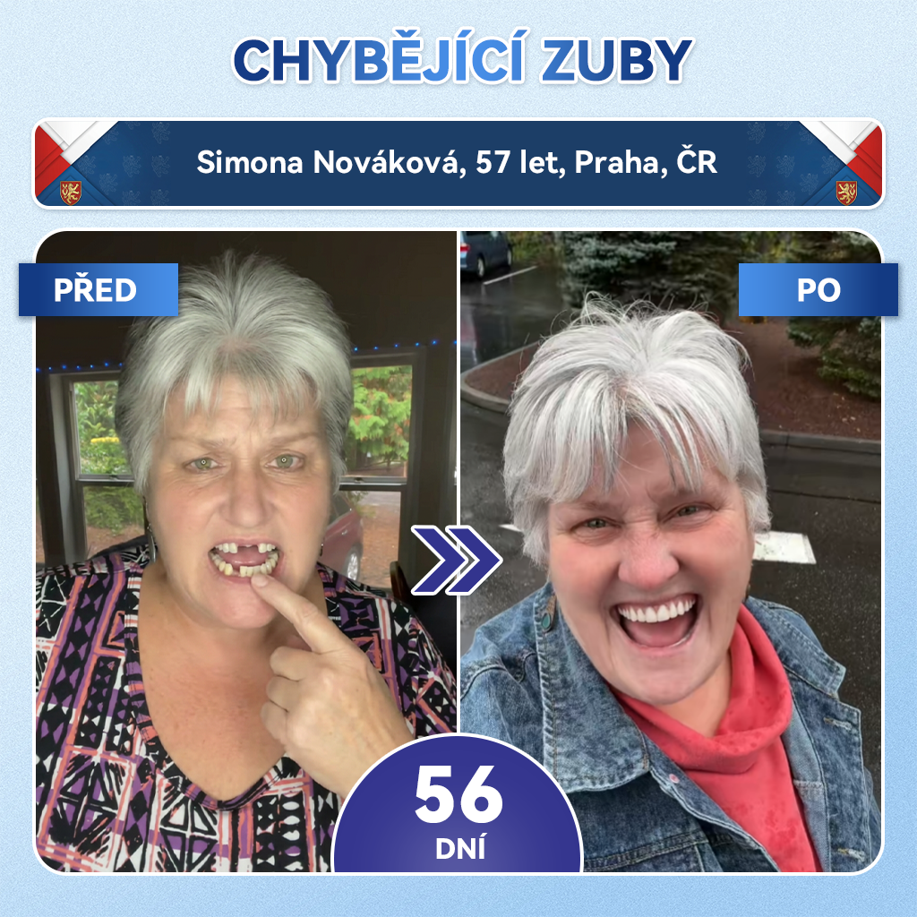 🦷Glimmerly® Microneedle naplast pro opravu zubi a dasni s Tideglusibem  |Pokročilé zubní pásky s aktivací kmenových buněk (obnovuje sklovinu a dentin • posiluje dásně • odstraňuje plak a zápach • zastavuje citlivost zubů) 3.0